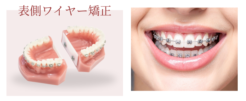 表側ワイヤー矯正