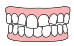 噛み合わせが悪い