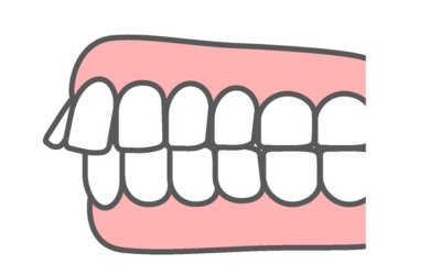 出っ歯と口呼吸