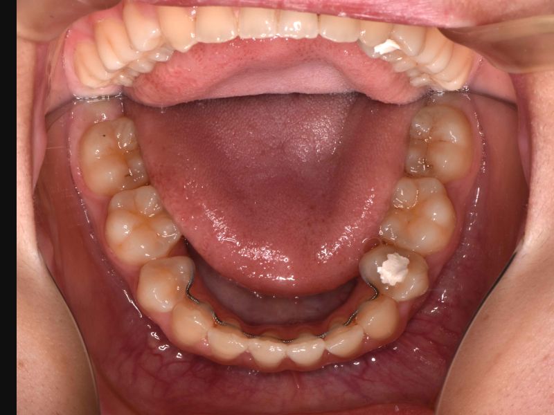 先天性欠如歯列の治療後の写真
