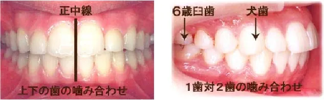 良い噛み合わせときれいな歯並びとは