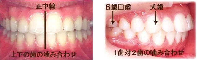 噛み合わせ