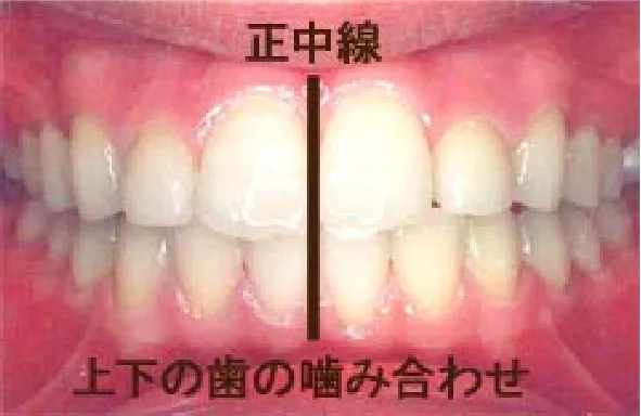 噛み合わせ