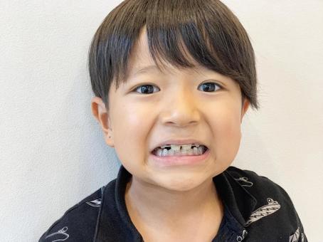 マウスピース作製・治療開始のイメージ