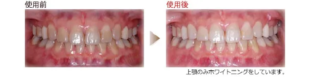 「輝く白さと美しさを」ホワイトニングのご案内 使用前と使用後