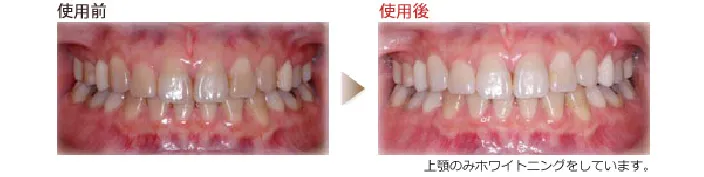 「輝く白さと美しさを」ホワイトニングのご案内 使用前と使用後