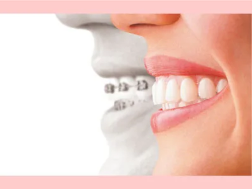 目立たない矯正装置の例